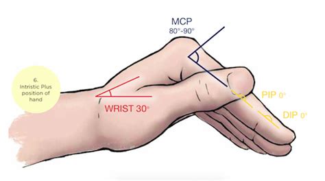 Wrist Fracture – EMCY