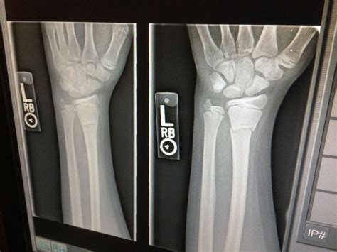 Broken Wrist X Ray | SexiezPicz Web Porn