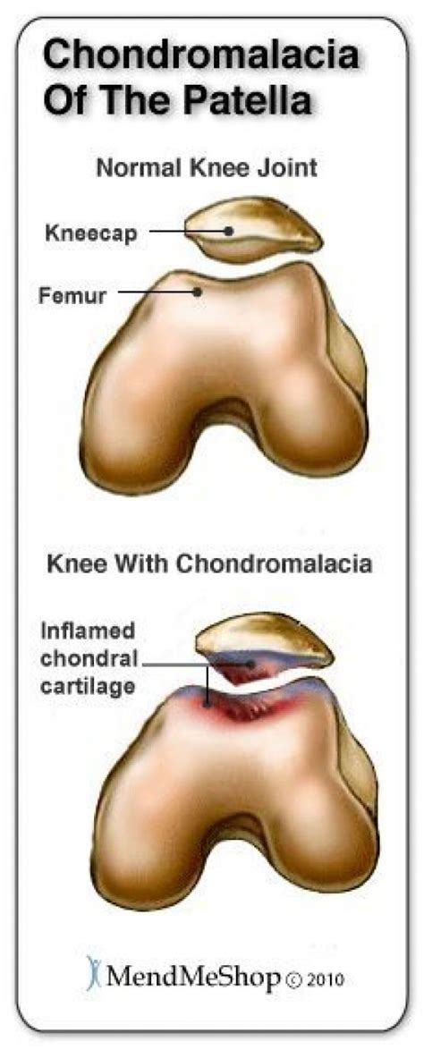 Patellar Chondromalacia occurs when the cartilage enabling the femur ...