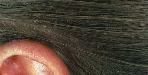 Top 161 + Lice and ticks in hair - polarrunningexpeditions