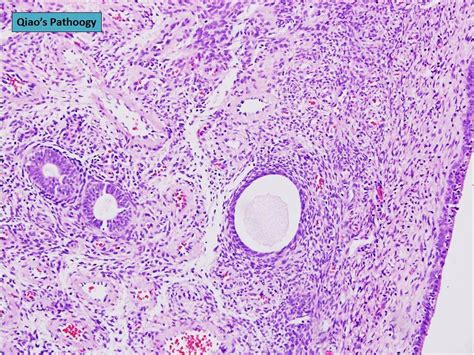 Qiao's Pathology: Mixed Endometrial-Endocervical type of Cervical Polyp ...