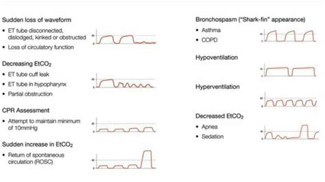 Wave form capnography | Emergency medicine, Icu nursing, Respiratory care