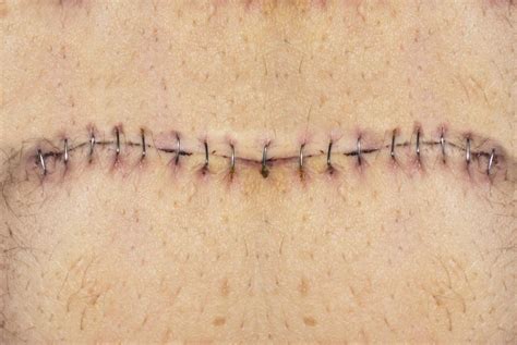 How Do I Treat an Itchy Incision? (with pictures)