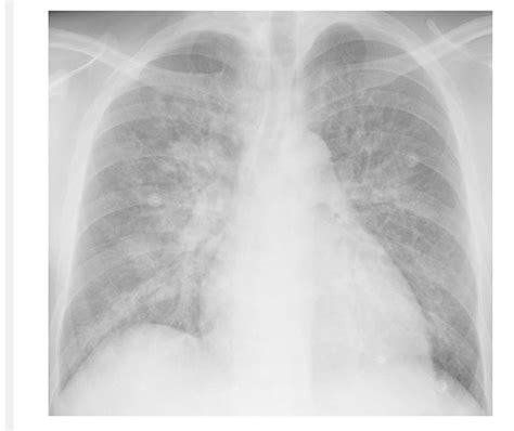 000 Cardiogenic Pulmonary Edema | Lungs