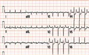 Unstable angina / non ST elevation myocardial infarction ...