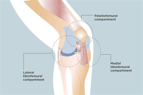 Tricompartmental Osteoarthritis: Symptoms, Diagnosis, Treatment