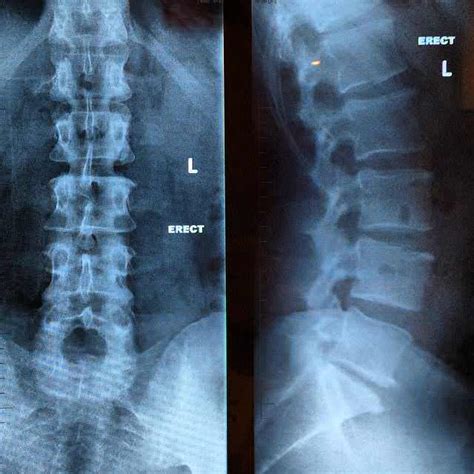 Spinal Osteoarthritis