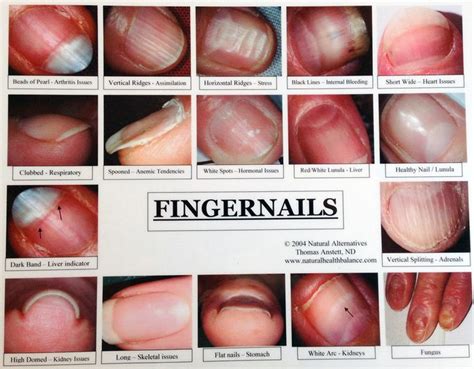 The 25+ best Nail diseases and disorders ideas on Pinterest | Skin hair ...