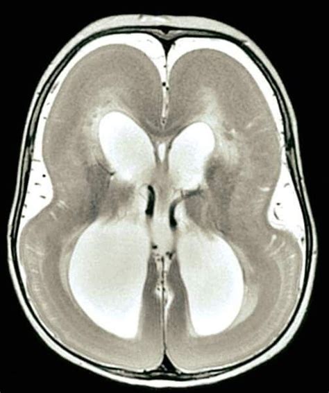 Figure 8 lissencephaly | Radiology, Human anatomy and physiology ...