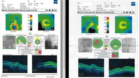 OCT scan interpretation : Ophthalmology