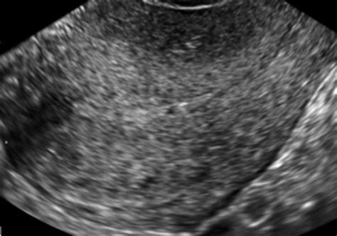 Sonography of Adenomyosis - Sakhel - 2012 - Journal of Ultrasound in ...