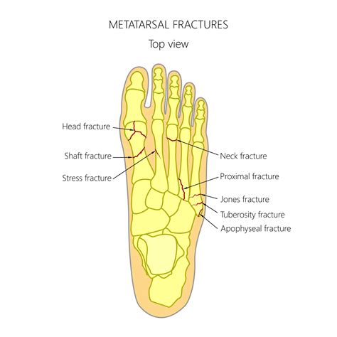 Metatarsal surgery | Foot Doctor Marietta | Learn More Now!