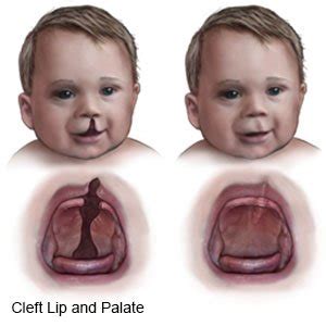 Cleft Lip and Cleft Palate Repair - What You Need to Know