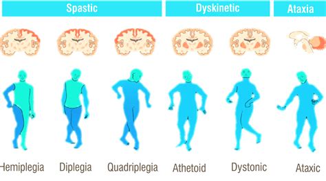 Cerebral Palsy - Pass The OT