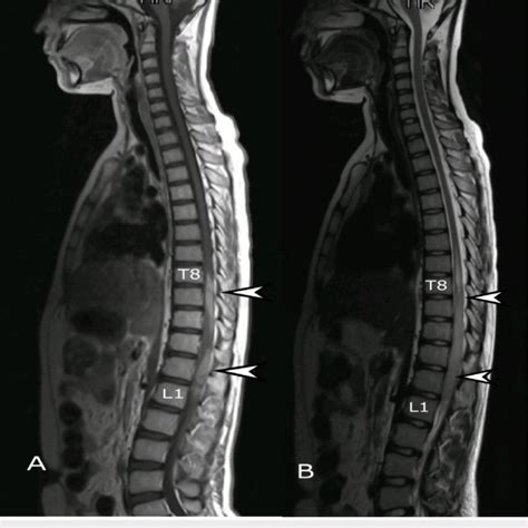 MRI whole spine, sagittal view. (A) T2 weighted and (B) T1 weighted ...