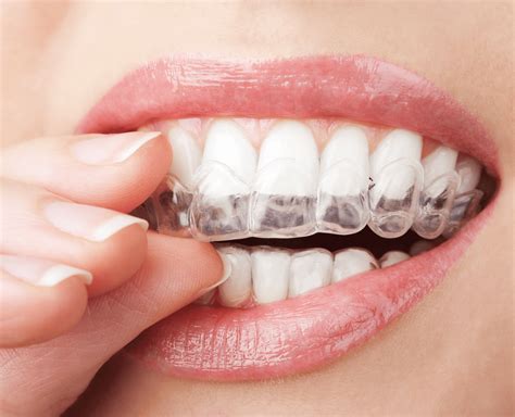 Compare Removable Braces with Fixed Braces - Pros and Cons