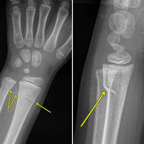 Fracture Torus Causes Symptoms Treatment Fracture Torus | SexiezPicz ...