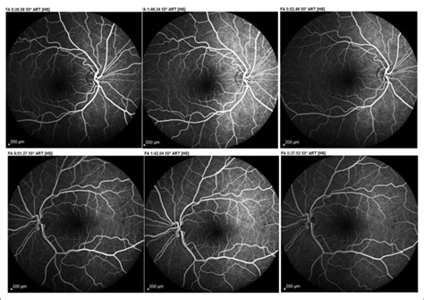 Fluorescein angiography (FA) images of the patient's right eye (top ...