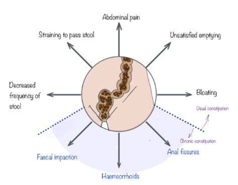 Constipation Causes, Symptoms, Risks, Treatment | Cape Town