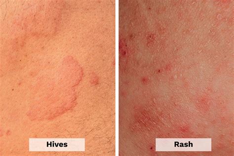 Hives vs. Rash: Here's How to Tell the Difference | The Healthy