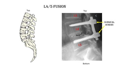 L 4/5 Fusion: Indications, Complications, & Treatments