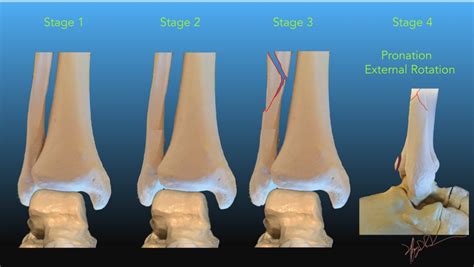 Lauge Hansen Classification of Ankle Fractures | UW Emergency Radiology