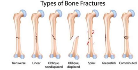 Fractures and Breaks - what's the difference? - Orthopaedic Surgery ...