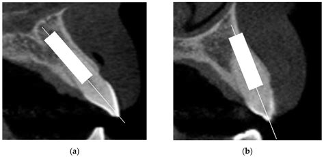 JCM | Free Full-Text | Immediate Implant Placement in the Maxillary ...