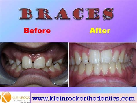 13 best Before and After Braces images on Pinterest | Bracelets, Braces ...