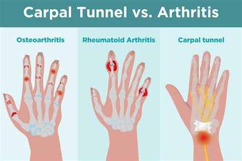 Carpal Tunnel Syndrome vs. Arthritis: What’s the Difference?