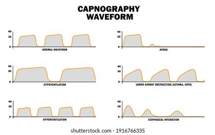 24 Capnography Waveform Images, Stock Photos & Vectors | Shutterstock