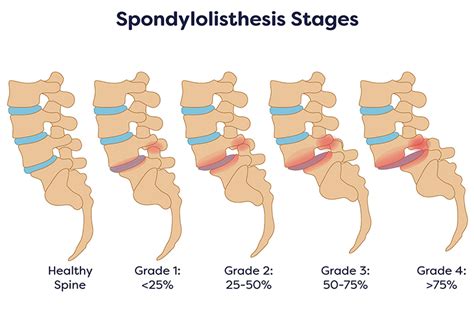 Spondylolisthesis Treatment in NJ and NYC