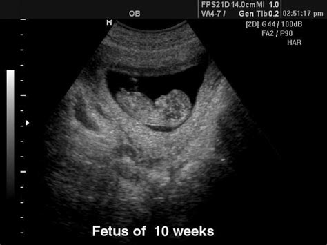 Ultrasound images - Fetus - 10 weeks, B-mode, echogramm №118