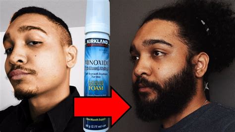 Before And After Minoxidil Beard ~ Minoxidil Before And After Beard ...