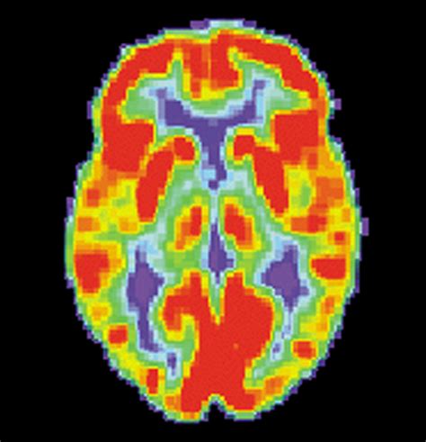 Brain positron emission tomography - Wikipedia