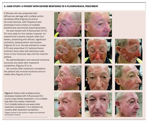 Actinic keratoses – a guide to treatment with 5-fluorouracil cream ...