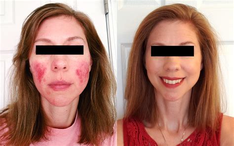 Rosacea Success Story: Persistence + Teamwork = a Clear Complexion ...