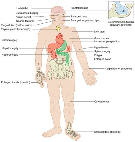 Acromegaly Tongue