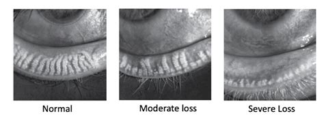 Lipiflow Dry Eye Treatment - Delaware Eye Care Center