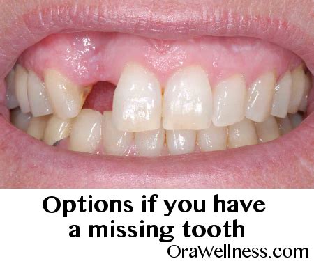 Fake Teeth Options - Dental News Network