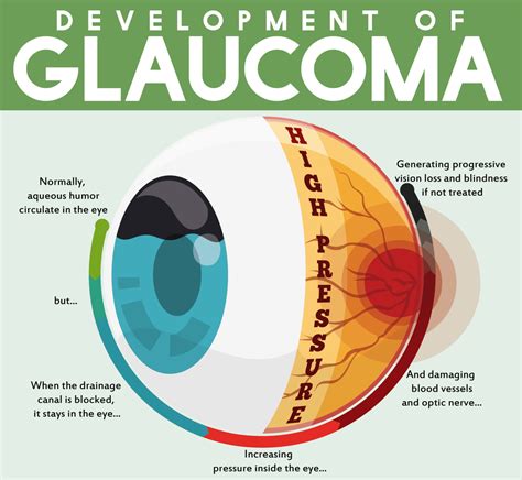 Glaucoma | Talley Eye Institute