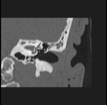 Perilymphatic fistula | Image | Radiopaedia.org