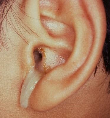 How to Deal with Ear Discharge « Know your body