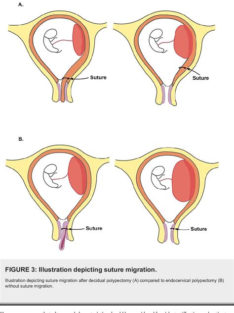 Figure 3 from Role of Ultrasound in Managing Cervical Polyps During ...