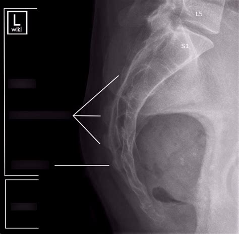 RADR-1411 Lat Sacrum/coccyx x-ray anatomy Diagram | Quizlet