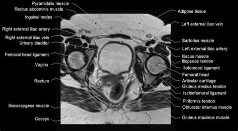 mri female pelvis anatomy axial im1age 2 | Pelvis anatomy, Pelvis, Hip ...