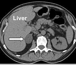 Adrenal incidentalomas