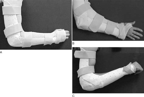 Posterior Elbow Splint