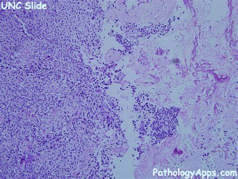 osteoblastic osteosarcoma bone, soft tissue histology