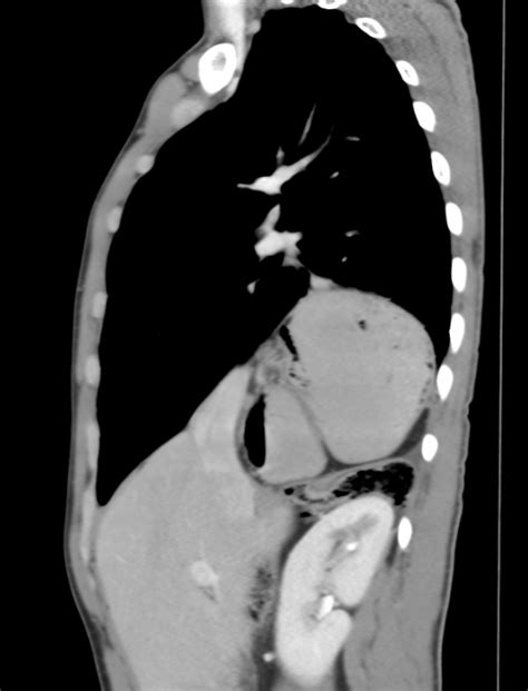 Bochdalek hernia | Image | Radiopaedia.org